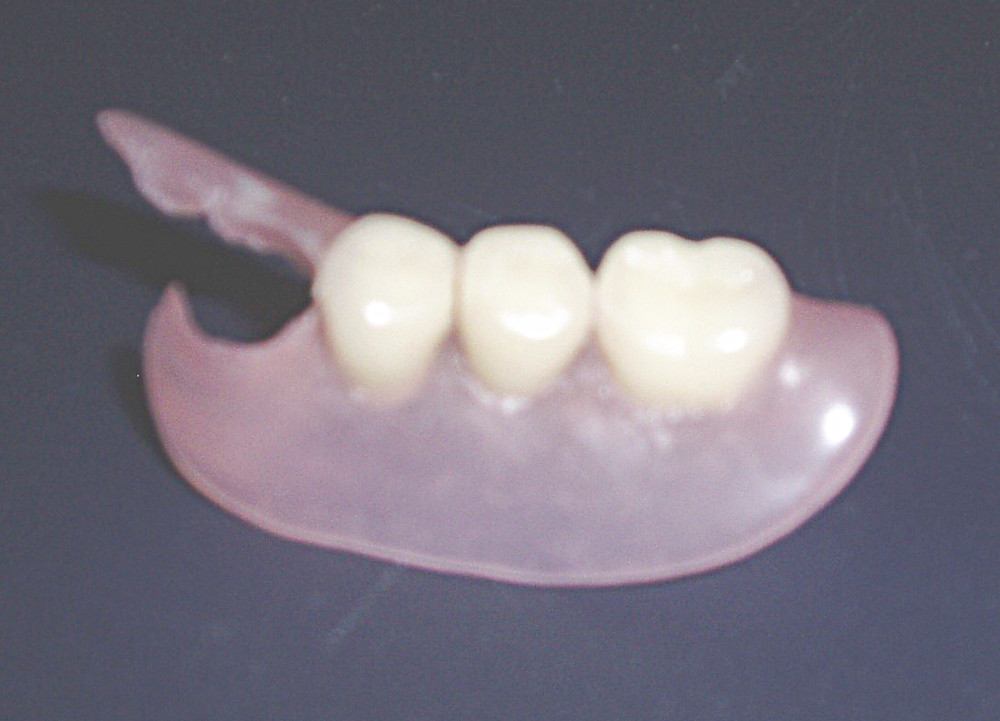 Зубной протез бабочка фото на нижнюю челюсть
